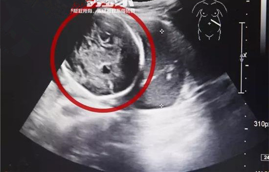 怀胎6月子宫竟然空了,孩子突然不见了?结局吓得一身冷汗!